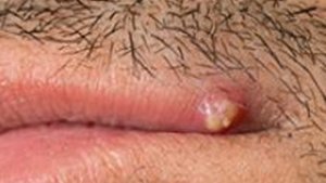 Der Abszess Der Abszess