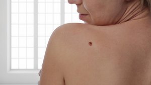 Wie gef&auml;hrlich sind Muttermale wirklich?