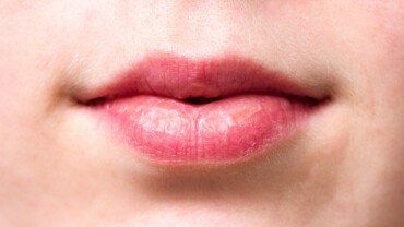Lippenherpes loswerden